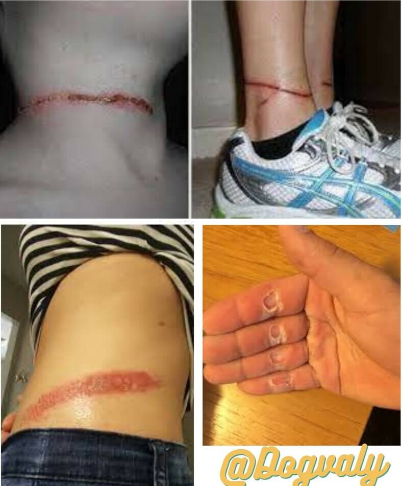 Reasons for rope burn from a dog leash