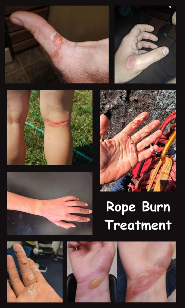 Rope burn treatment